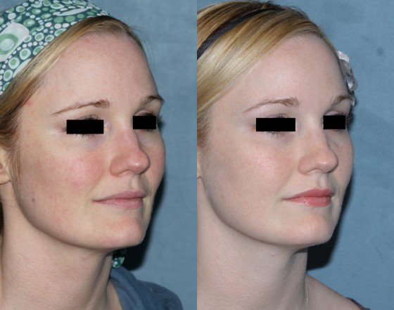 587882VbeamFiller-2