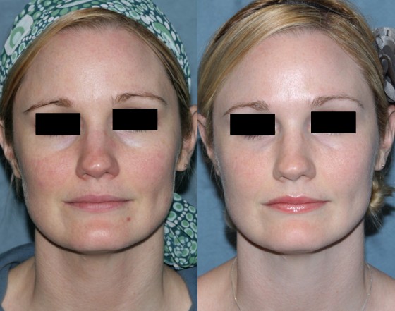 587882VbeamFiller