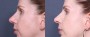 Dr. Grzeskiewicz Chin Enlargement Patient 2