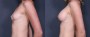 Dr. Roark Breast Augmentation Patient 10