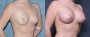 Dr. Roark Breast Augmentation Patient 9