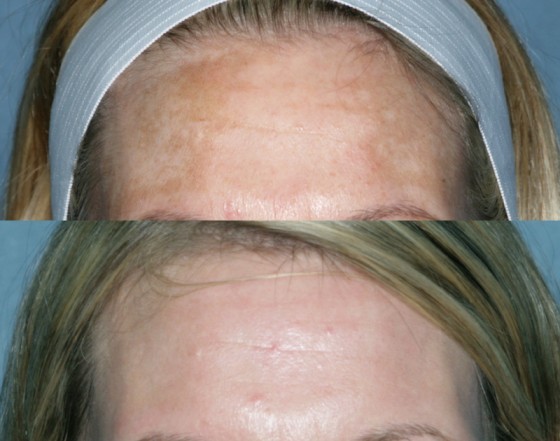 82419RepairMelasma1