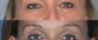 Dr. Grzeskiewicz Eyelid Lift Patient 3