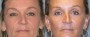 Dr. Grzeskiewicz Facelift Patient 1
