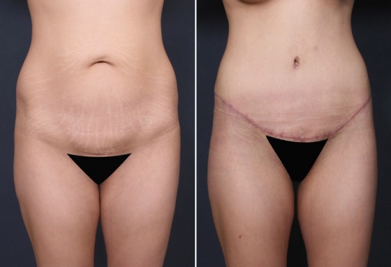 Dr-Brahme-abdominoplasty-01a