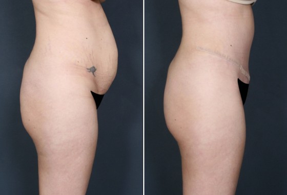Dr-Brahme-abdominoplasty-02