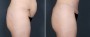 Dr. Brahme Tummy Tuck Patient 4