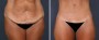Dr. Brahme Tummy Tuck Patient 3