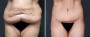Dr. Brahme Tummy Tuck Patient 5