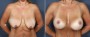 Dr. Brahme Breast Lift Patient 2