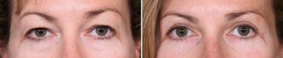 Dr-Brahme-eyelids-01a