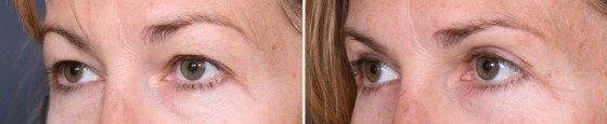 Dr-Brahme-eyelids-01b