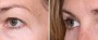 Dr. Brahme Eyelid Lift Patient 2
