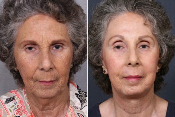 Dr-Brahme-facelift-02a