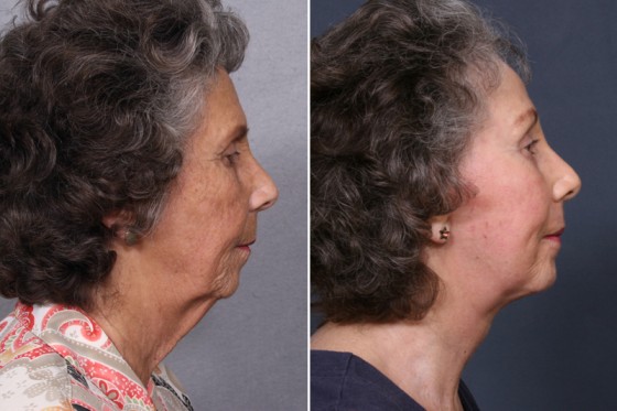 Dr-Brahme-facelift-02c