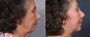 Dr. Brahme Facelift Patient 4