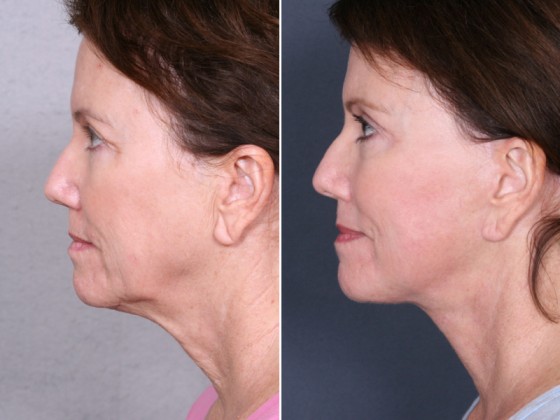 Dr-Brahme-facelift-03c