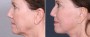 Dr. Brahme Facelift Patient 5