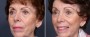 Dr. Brahme Facelift Patient 3