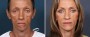 Dr. Brahme Facelift Patient 2