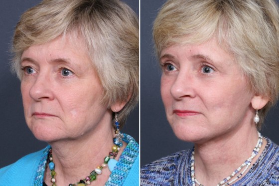 Dr. Brahme Facelift Patient 1