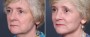 Dr. Brahme Facelift Patient 1