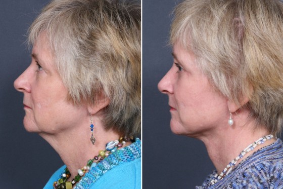 Dr-Brahme-facelift-06c