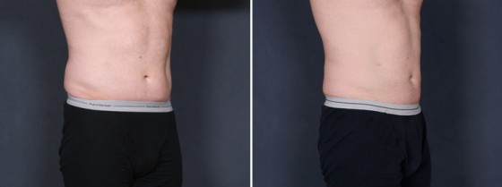 Dr-Brahme-male-lipo-abs-01b