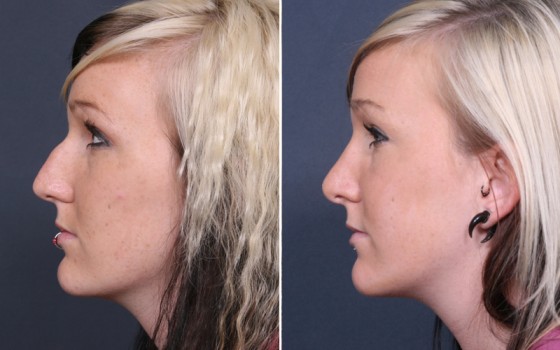 Dr-Brahme-rhinoplasty-01c