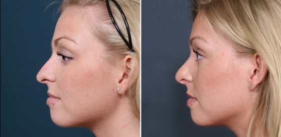 Dr-Brahme-rhinoplasty-02c