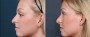 Dr. Brahme Rhinoplasty Patient 10