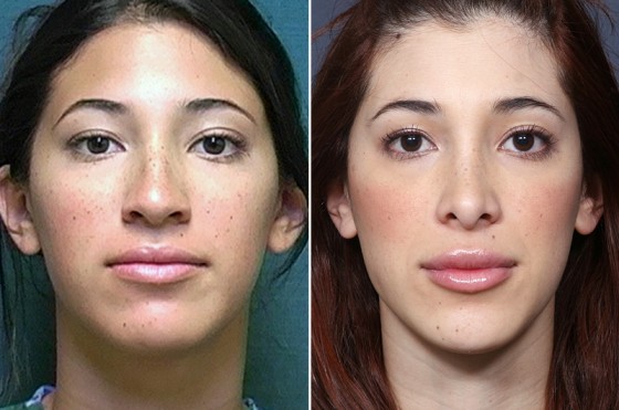 Dr-Brahme-rhinoplasty-03a