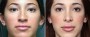 Dr. Brahme Rhinoplasty Patient 9