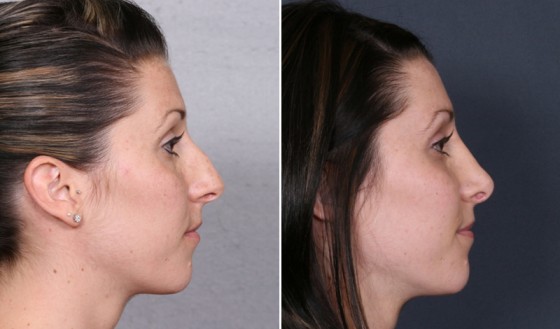 Dr-Brahme-rhinoplasty-04c