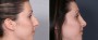 Dr. Brahme Rhinoplasty Patient 8