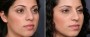 Dr. Brahme Rhinoplasty Patient 7