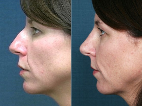 Dr-Brahme-rhinoplasty-06c