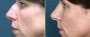 Dr. Brahme Rhinoplasty Patient 6