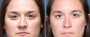 Dr. Brahme Rhinoplasty Patient 5