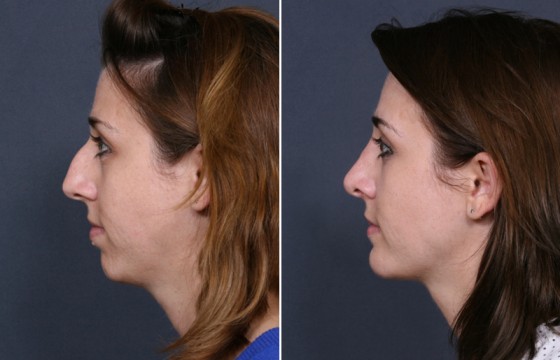 Dr-Brahme-rhinoplasty-08c