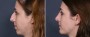 Dr. Brahme Rhinoplasty Patient 3