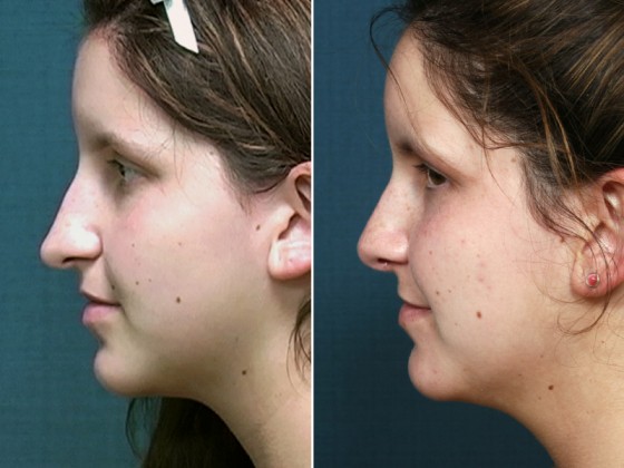 Dr-Brahme-rhinoplasty-09c