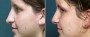 Dr. Brahme Rhinoplasty Patient 4