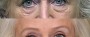 Dr. Brahme Eyelid Lift Patient 4
