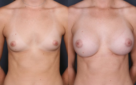 HMR-Breast-Augmentation3