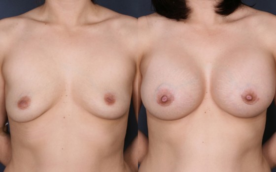 HMR-Breast-Aumentation-1