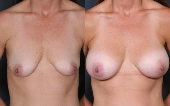 HMR-Breast-Aumentation2