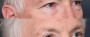 Dr. Roark Eyelid Lift Patient 3