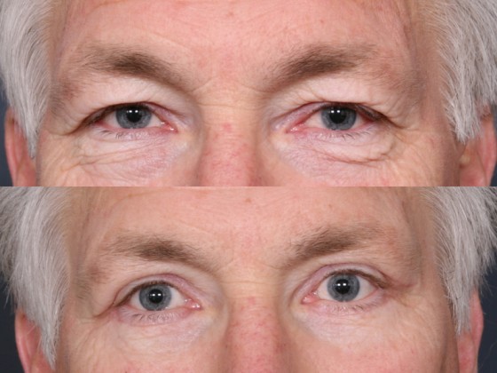 HMR-EyelidLift-1