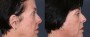 Dr. Roark Neck Lift Patient 1